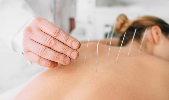 Dry needling treatment being applied at CornerPoint Physiotherapy